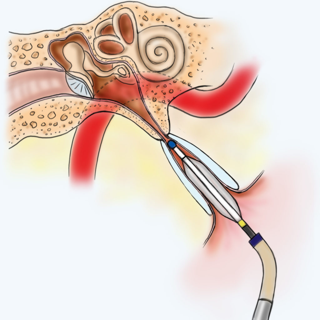 Eustachian Tube Balloon Dilation Ear & Sinus Institute